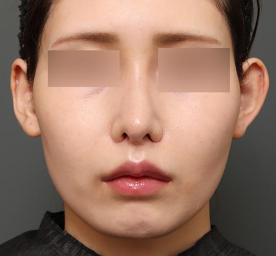 20代女性の人中短縮(リップリフト) After 症例写真