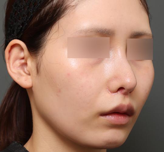20代女性の人中短縮(リップリフト) After 症例写真