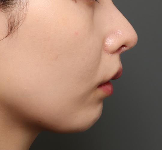 20代女性の人中短縮(リップリフト) After 症例写真