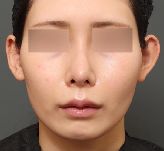 20代女性の人中短縮(リップリフト) Before 症例写真