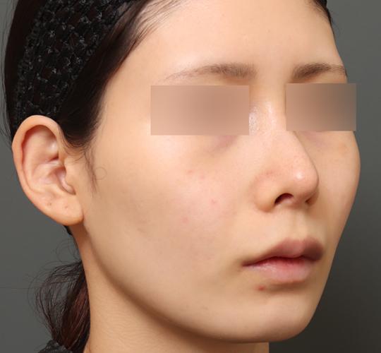 20代女性の人中短縮(リップリフト) Before 症例写真