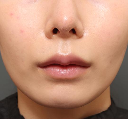 20代女性の人中短縮(リップリフト) Before 症例写真