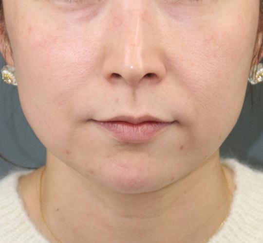 40代女性の毛穴・黒ずみ Before 症例写真