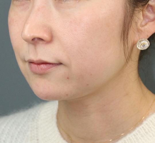 40代女性の肌管理毛穴スリークスキン（ダーマペン4） Before 症例写真