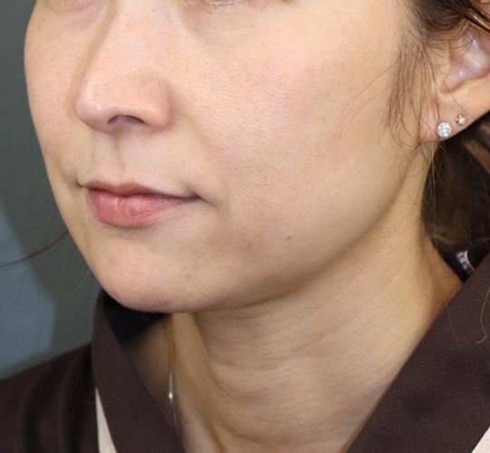 40代女性の肌管理毛穴スリークスキン（ダーマペン4） After 症例写真