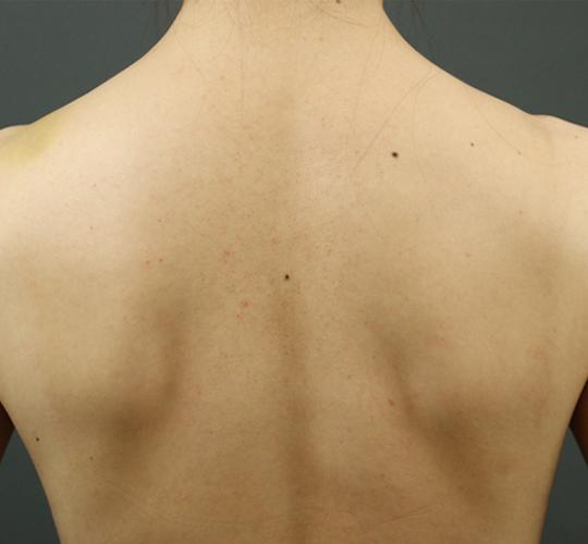 30代女性の毛孔性苔癬・角化症 After 症例写真