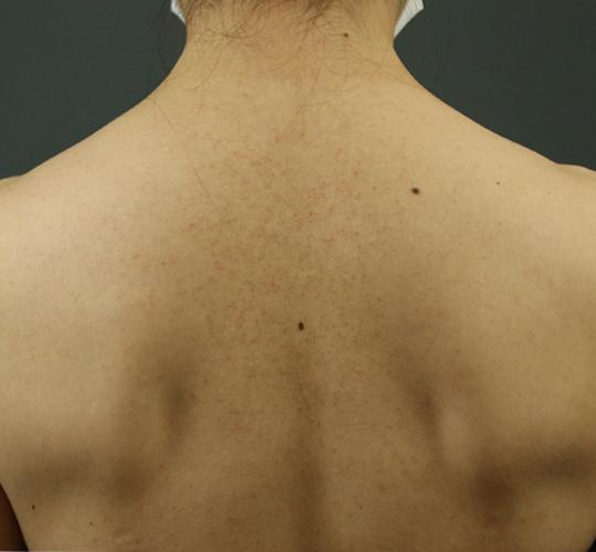 30代女性の毛孔性苔癬・角化症 Before 症例写真