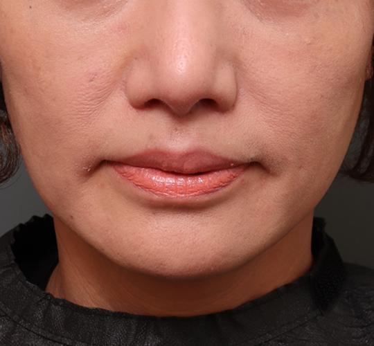 50代女性の人中短縮（リップリフト） After 症例写真
