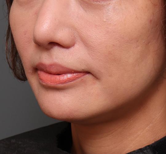 50代女性の唇・口元の整形 After 症例写真