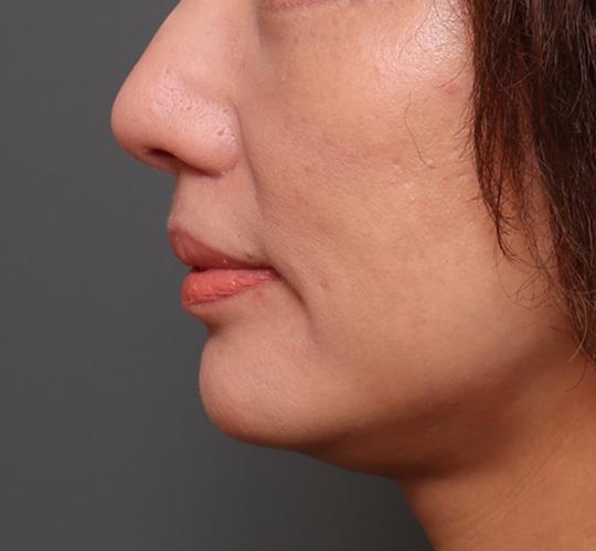 50代女性の人中短縮（リップリフト） After 症例写真