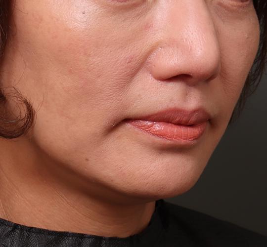 50代女性の人中短縮（リップリフト） After 症例写真