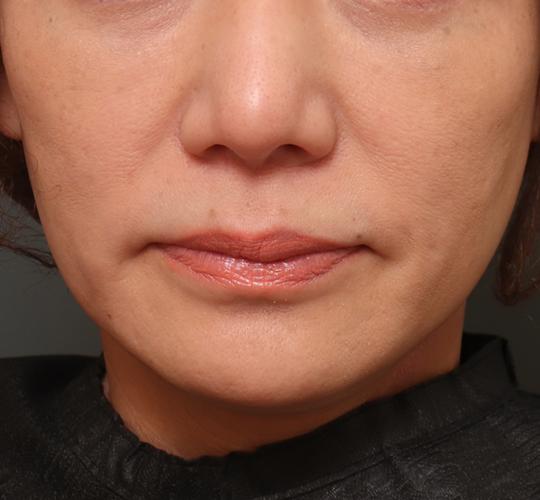 50代女性の人中短縮（リップリフト） Before 症例写真