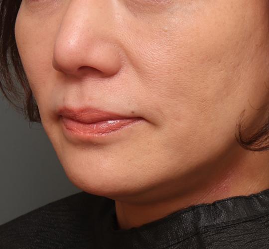 50代女性の唇・口元の整形 Before 症例写真