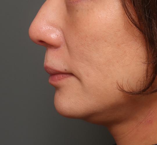 50代女性の人中短縮（リップリフト） Before 症例写真