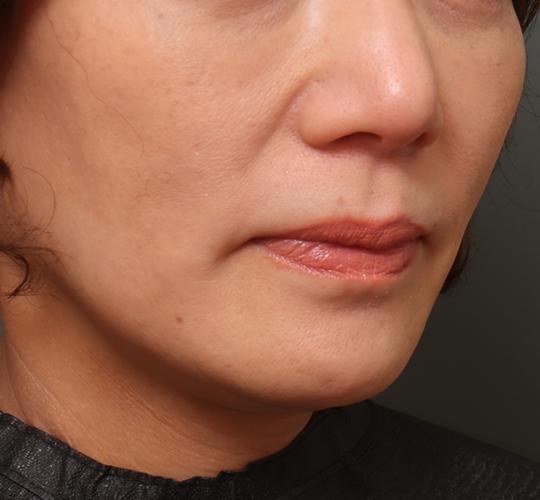 50代女性の人中短縮（リップリフト） Before 症例写真