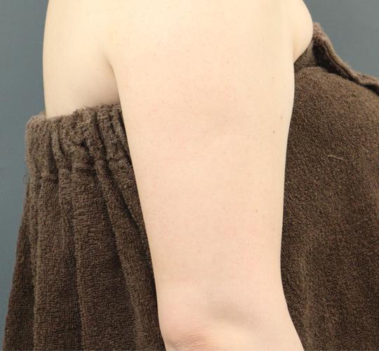 30代女性の毛孔性苔癬・角化症 After 症例写真