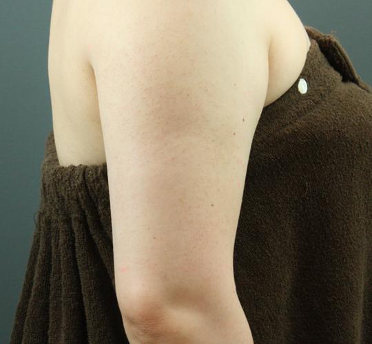 30代女性の毛孔性苔癬・角化症 Before 症例写真