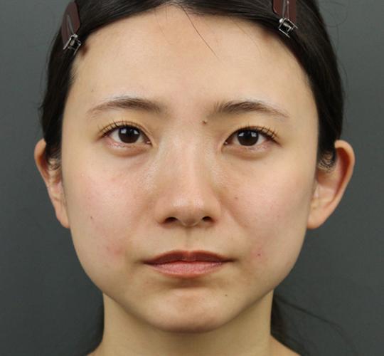 20代女性のシワ・たるみ After 症例写真