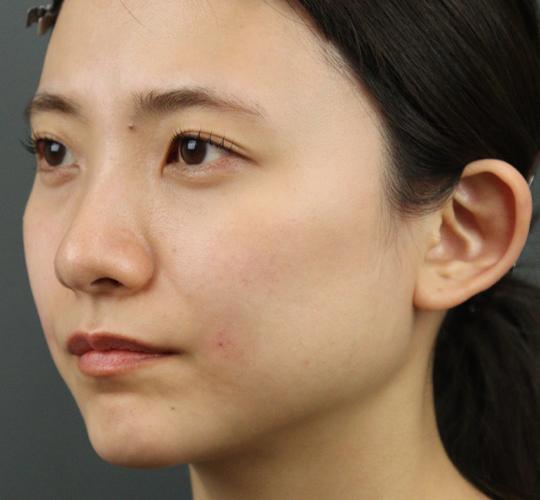 20代女性のヒアルロン酸注射（ほうれい線） After 症例写真