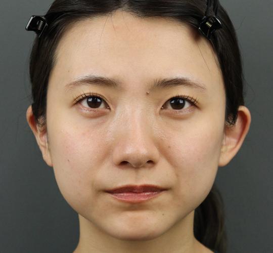 20代女性のシワ・たるみ Before 症例写真