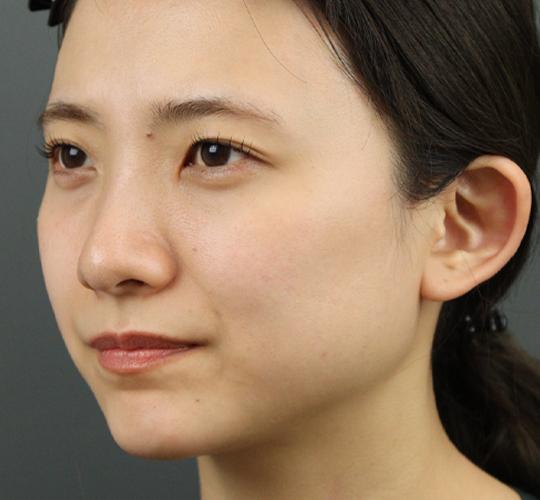 20代女性のヒアルロン酸注射（ほうれい線） Before 症例写真