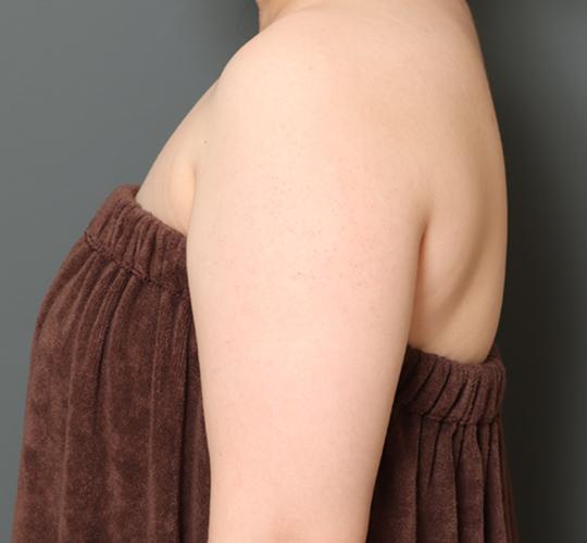 30代女性の毛孔性苔癬・角化症 After 症例写真