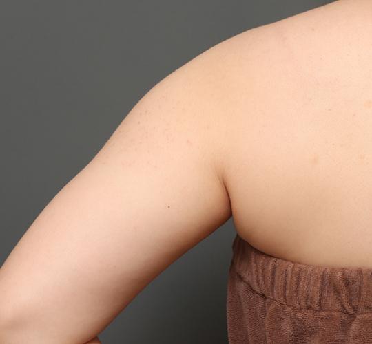 30代女性のFotonaフラクショナルレーザー(毛孔性苔癬) Before 症例写真