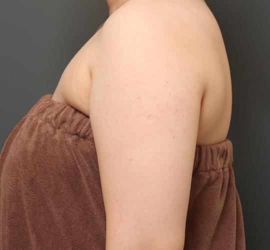 30代女性の毛孔性苔癬・角化症 Before 症例写真