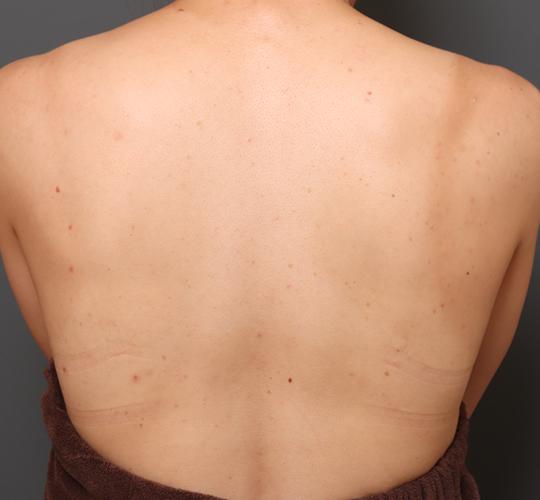 30代女性の美肌治療 After 症例写真