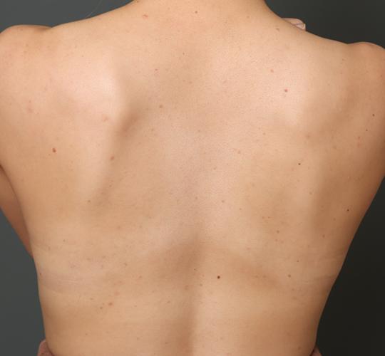 30代女性の美肌治療 Before 症例写真