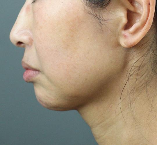 50代女性のエラ・アゴ・小顔 After 症例写真