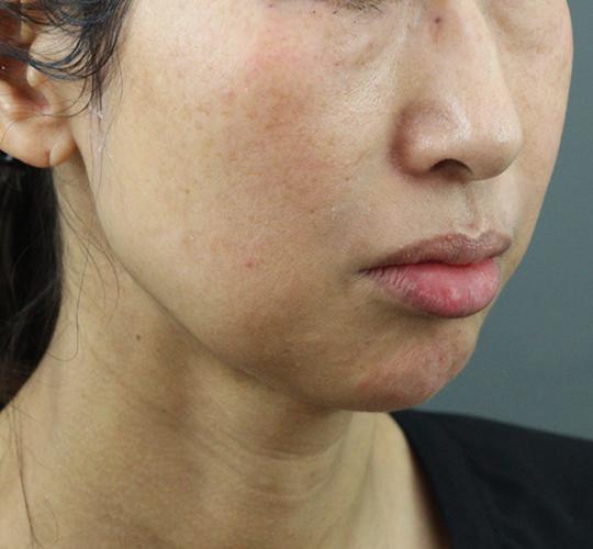 50代女性のヒアルロン酸注射(アゴ形成) After 症例写真