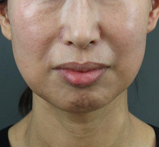 50代女性のヒアルロン酸注射(アゴ形成) Before 症例写真