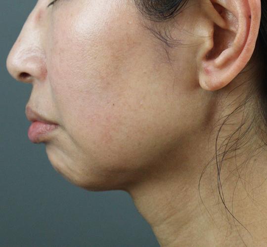 50代女性のエラ・アゴ・小顔 Before 症例写真