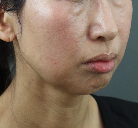 50代女性のヒアルロン酸注射(アゴ形成) Before 症例写真