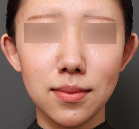 20代女性の人中短縮(リップリフト) After 症例写真