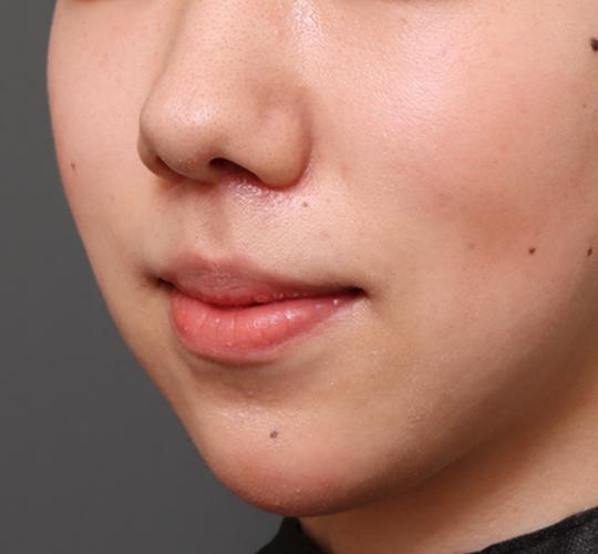 20代女性の人中短縮(リップリフト) After 症例写真