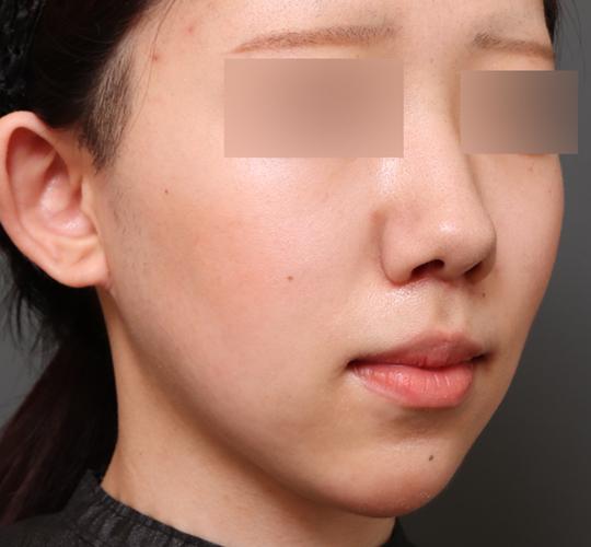 20代女性の唇・口元の整形 After 症例写真