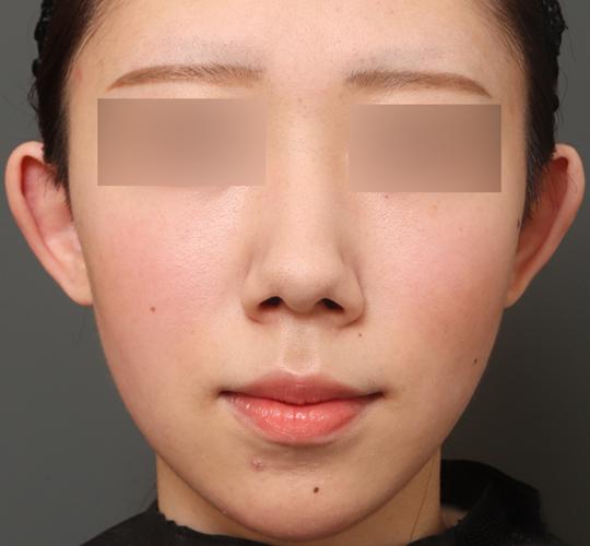 20代女性の人中短縮(リップリフト) Before 症例写真