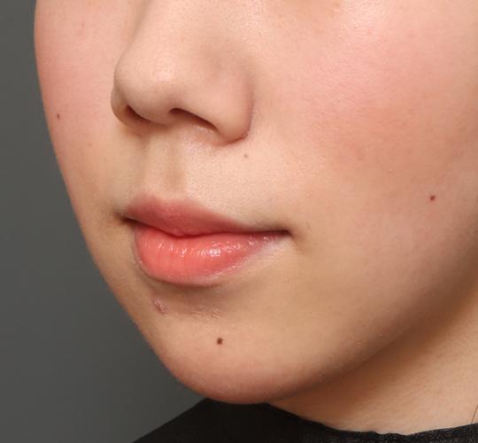 20代女性の人中短縮(リップリフト) Before 症例写真