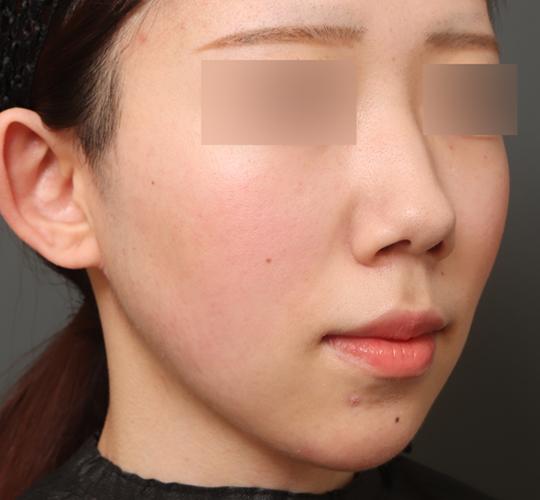 20代女性の唇・口元の整形 Before 症例写真