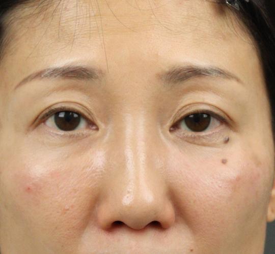 40代女性のヒアルロン酸注射(目の下) After 症例写真