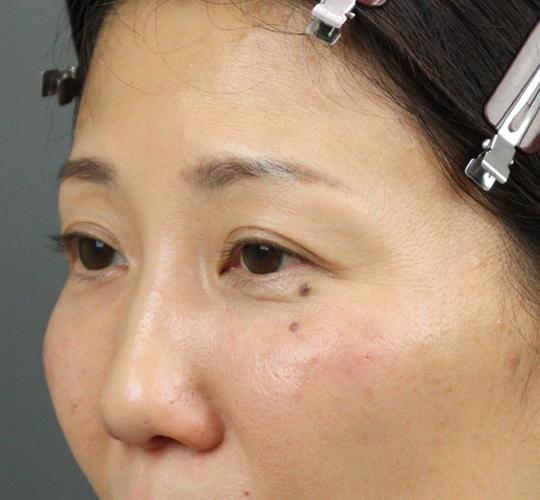 40代女性のヒアルロン酸注射(目の下) After 症例写真