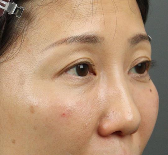 40代女性のヒアルロン酸注射(目の下) After 症例写真