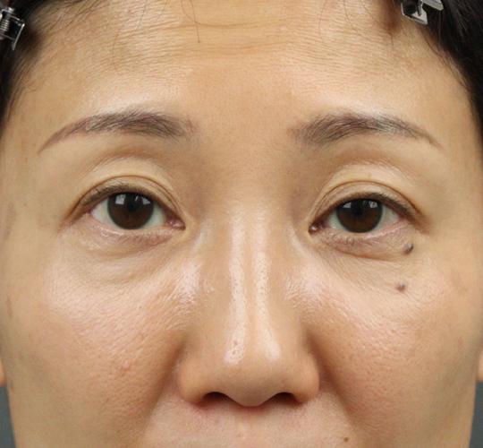 40代女性のヒアルロン酸注射(目の下) Before 症例写真