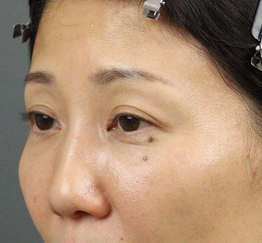 40代女性のヒアルロン酸注射(目の下) Before 症例写真