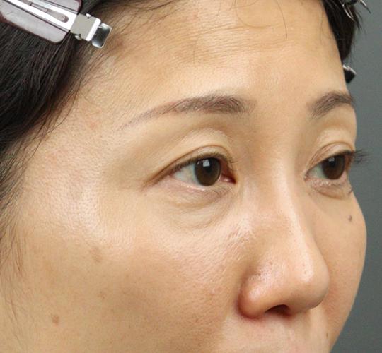 40代女性のヒアルロン酸注射(目の下) Before 症例写真