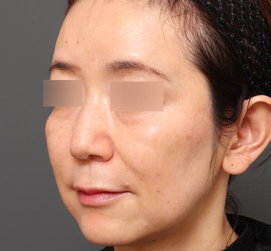 50代女性のヒアルロン酸注射  After 症例写真