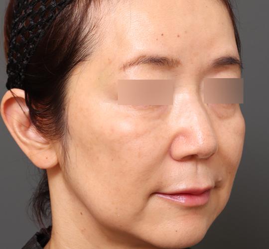 50代女性のヒアルロン酸注射  After 症例写真