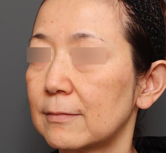 50代女性のヒアルロン酸注射  Before 症例写真